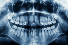 A dental x-ray of a teeth in a mouth.